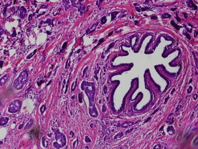 A breast tumor stained with Hematoxylin and Eosin. The type of Breast cancer is called Infiltrating ductal carcinoma of the breast.